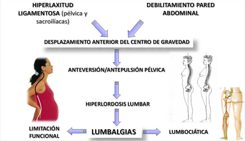 Desequilibrio y compensación del cuerpo durante la gestación.