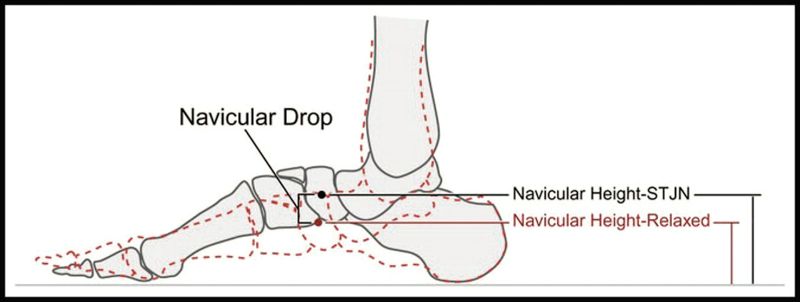 Imagen 12 y 13.- Navicular Drop (ND)